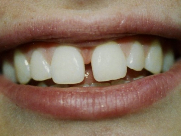 teeth tooth gaps why gap grow patch come braces dentist dental smile open causes perfect silver filling