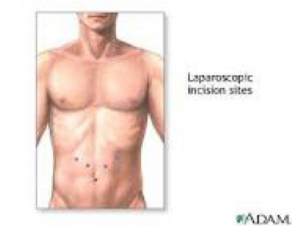 what-does-laparoscopic-and-minimally-invasive-surgery-really-mean