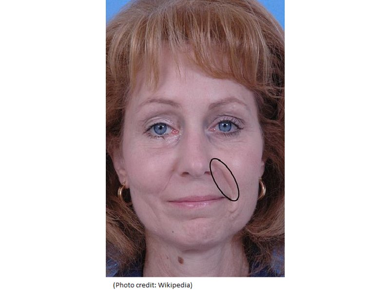 A First For Greater Phila. Region Residents Aging lines at Nose & Mouth