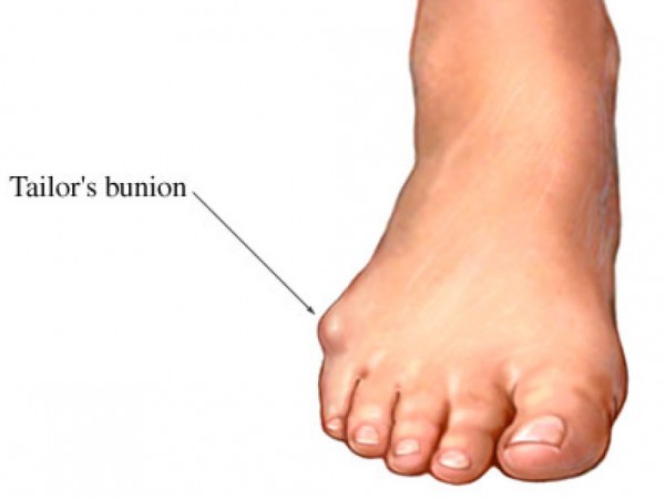 bump-on-the-middle-outside-of-the-foot-home-treatment-guide