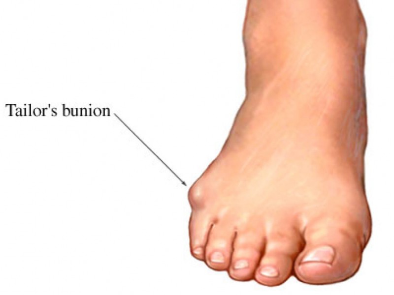 ganglion-cysts-on-feet-northwest-foot-care-dr-frank-cobarrubia