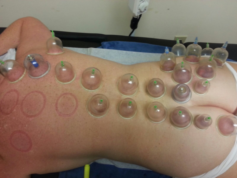 cupping-treatment-relieves-back-pain-and-stress-peachtree-corners-ga