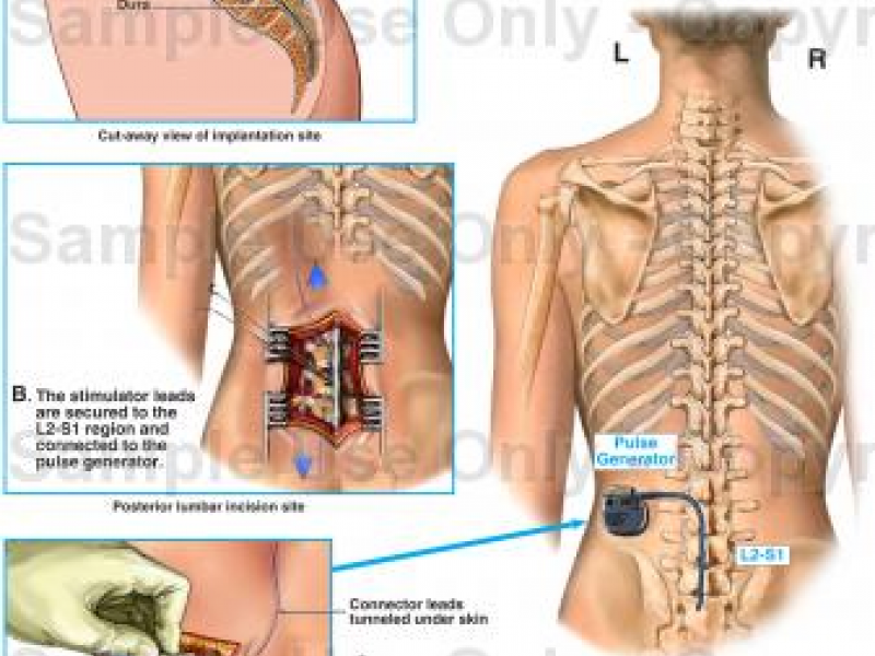 dorsal column stimulator surgery