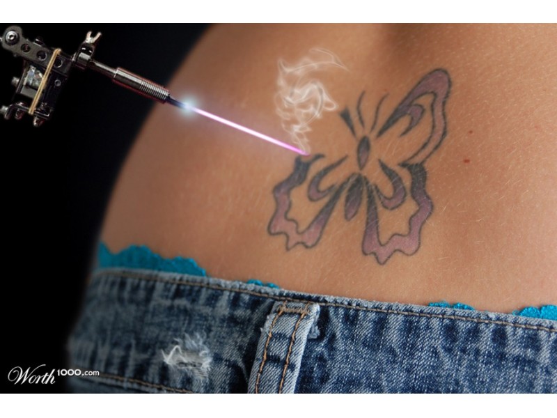 PAINLESS TATTOO REMOVAL Canton, MA Patch