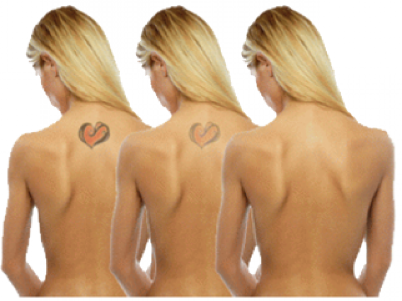 the safest and fastest way to remove a tattoo brookline ma patch the safest and fastest way to remove a tattoo brookline ma patch