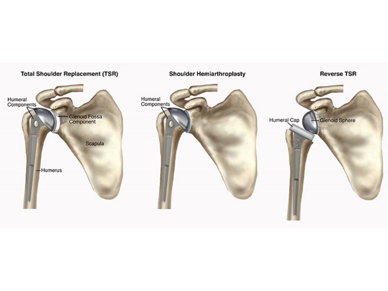 Guide to Total Shoulder Replacement | Oakland Township, MI Patch