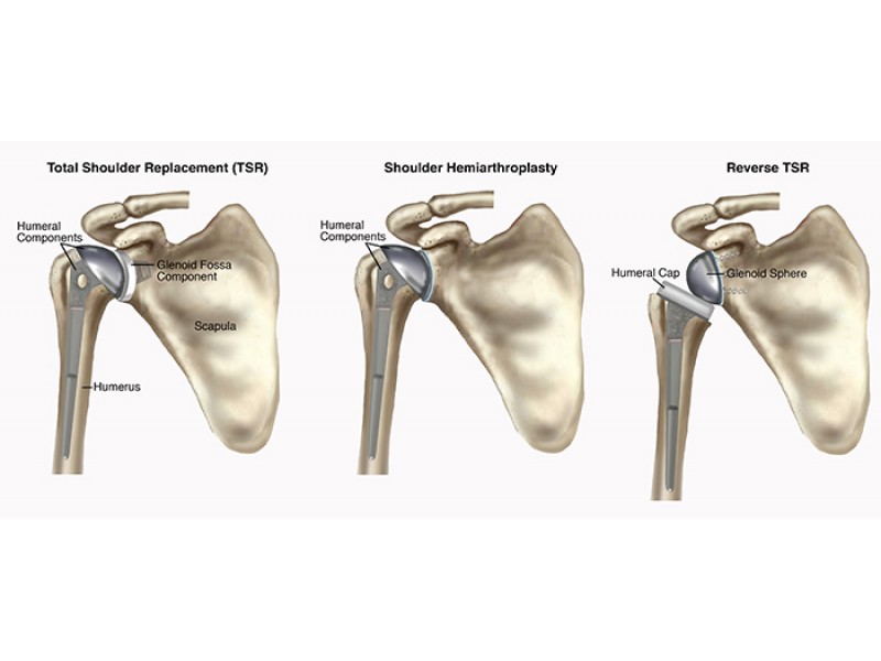 Guide to Total Shoulder Replacement Oakland Township, MI Patch