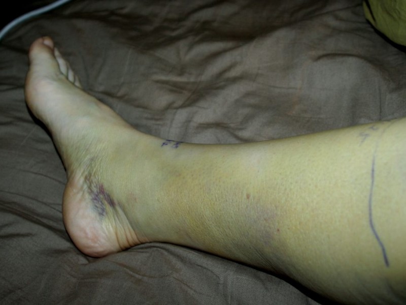 What to do if a Rattlesnake Bites You Los Gatos, CA Patch