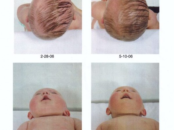 abnormal head shapes abnormal head shapes