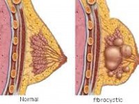 natural remedy for fibrocystic breast changes