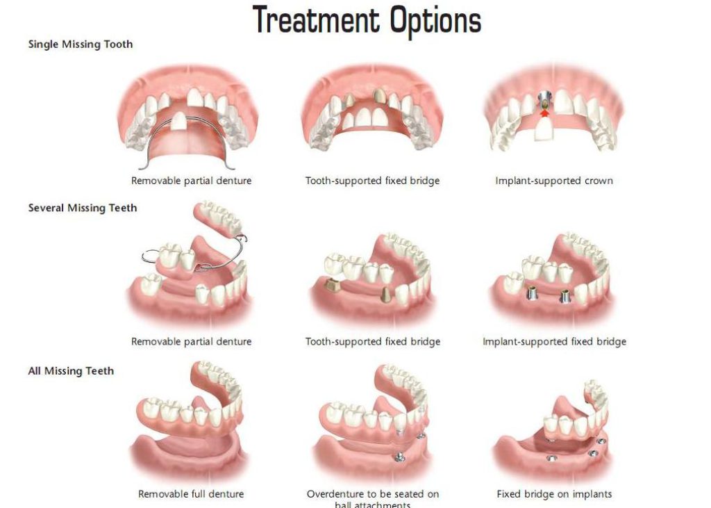 moorestown-denture-alternatives-for-seniors-moorestown-nj-patch