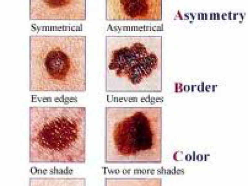 Dermatologist Recommends Full Body Check For Detecting Skin Cancer ...