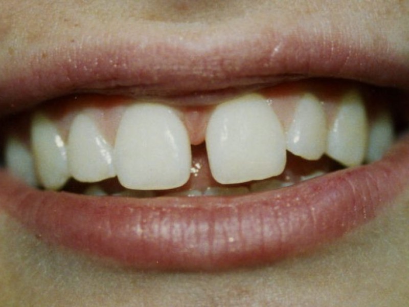 teeth gaps why grow dentist patch smile come perfect silver open