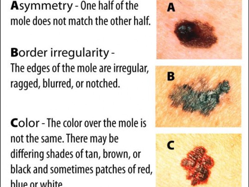 Mole Check: Know Your ABCD's | Upper Dublin, PA Patch